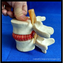 Enlarge Demonstration Lumbar Disc Herniation Model